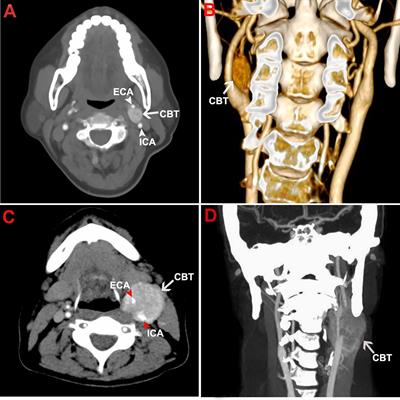 Comparison of Contrast-Enhanced Ultrasonography to Color Doppler Ultrasound in Evaluation of Carotid Body Tumors